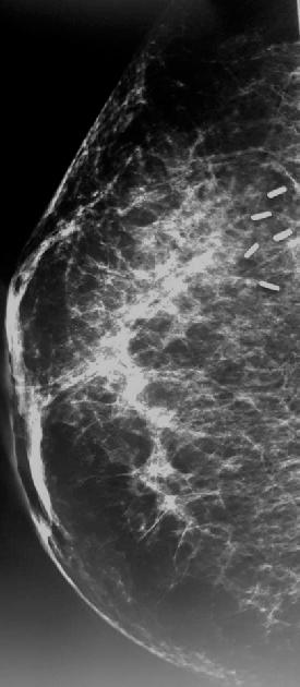 Figure 2.Mammography of right breast.in CC and MLO views microcalcifications and surgical clips can be seen. Figure 3. Mammography of right breast.