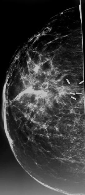 Focal compression magnification view (CC) Discussion Breast-conserving therapy is the mainstay of treatment in most breast cancer patients for
