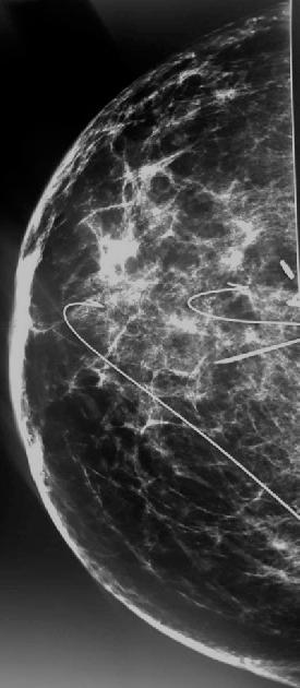 For many years, Figure 5. Specimen mammography which shows microcalcifications have been excised.