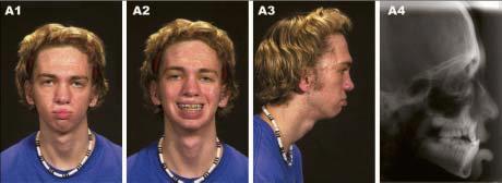 Facial Balance in Cleft Orthognathic surgery Figure 8A: (A) A 17 year-old patient with bilateral complete cleft