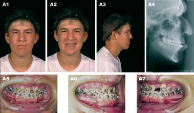 orthodontic brackets (A7) Left oblique view with orthodontic brackets Figure 9B: (B) Patient at 20 years of age demonstrating long-term outcome after a four-piece Lefort I osteotomy with maxillary
