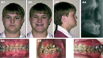(A1) Frontal view (A2) Frontal smiling (A3) Right lateral view (A4) Preoperative lateral cephalometric roentgenogram (A5) Frontal view with orthodontic brackets (A6) Right oblique view with