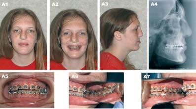 Salyer, et al. Figure 11A: (A) A 16 year-old patient with unilateral complete cleft lip/nose, alveolus and palate after completion of growth and before orthognathic surgery.