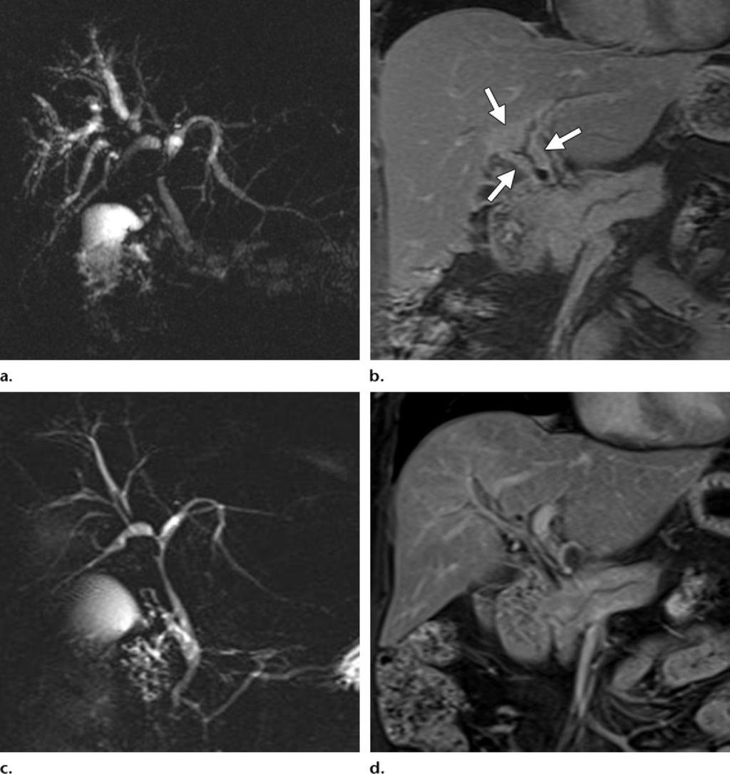 Figure 13. Biliary involvement in a 66-year-old woman with autoimmune pancreatitis.