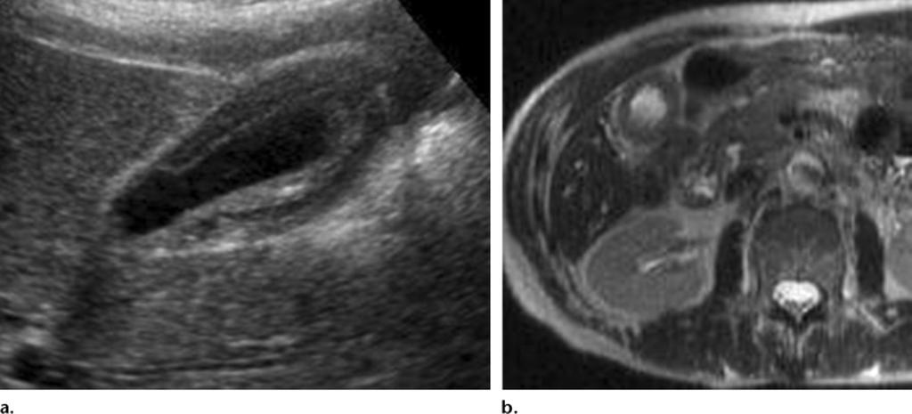 Gallbladder involvement in an 83-year-old man. (a) Sagittal US image shows marked thickening of the gallbladder wall, which appears hypoechoic.