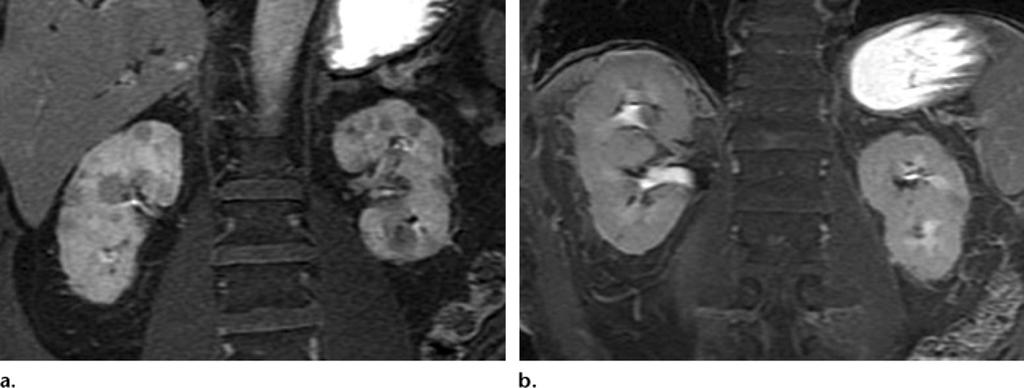 Figure 16. Renal involvement in a 74-year-old man. (a) Coronal T2-weighted MR image shows multiple bilateral round, hypointense, cortical lesions in the kidneys.