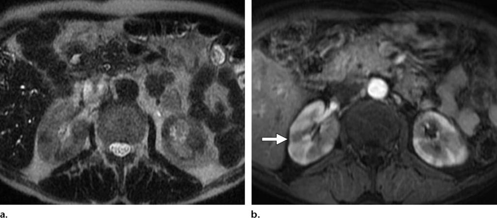 The patient did not undergo steroid therapy; however, right hemihepatectomy was performed for suspected cholangiocarcinoma, which turned out to be sclerosing cholangitis related to autoimmune