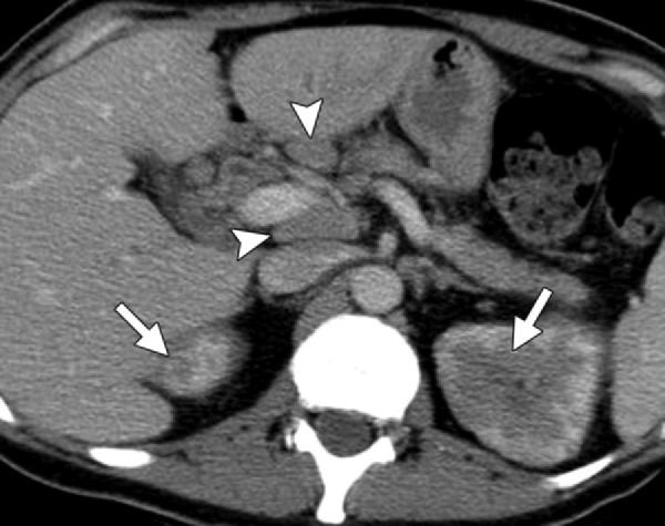 (b) Transverse contrast-enhanced T1-weighted MR image, obtained in the corticomedullary phase, shows small bilateral hypointense nodules in the peripheral renal cortex and marked thickening of the