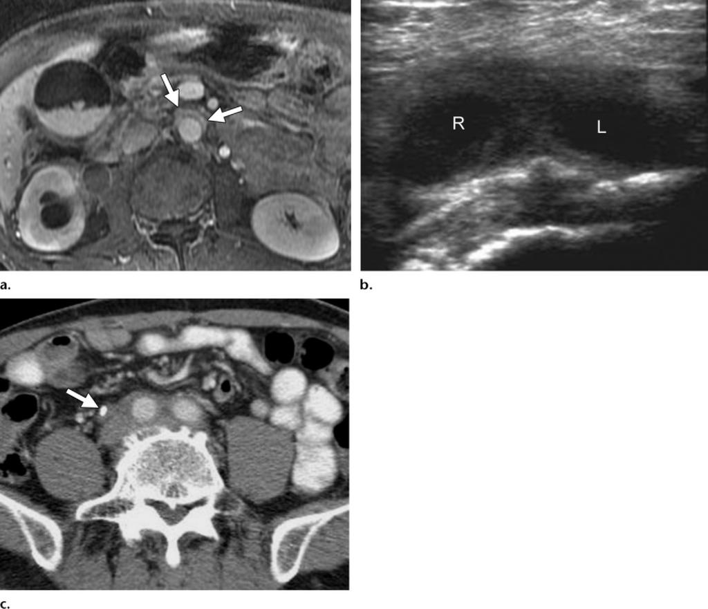 Figure 20. Retroperitoneal fibrosis in a 59-year-old man. (a) Contrast-enhanced T1-weighted MR image shows an area of enhancing soft-tissue thickening (arrows) anterior to the aorta.