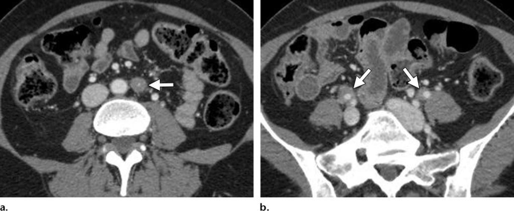 1394 September-October 2011 radiographics.rsna.org Figure 21. Retroperitoneal fibrosis in a 46-year-old woman.