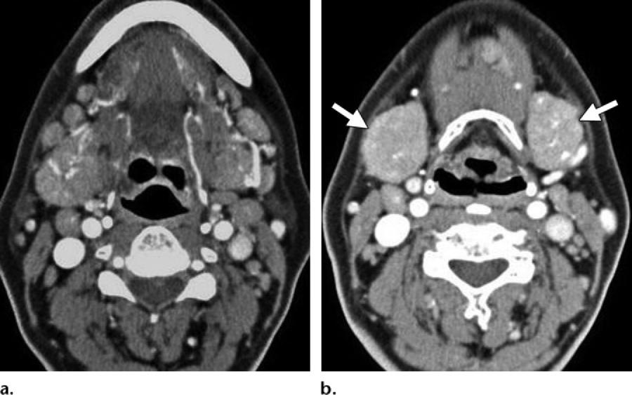 Figure 23. Salivary gland involvement in a 46-year-old man.
