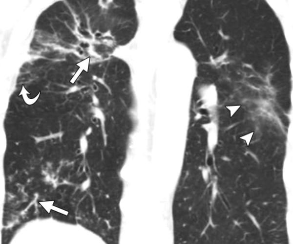 Figure 26. Pulmonary involvement in a 75-year-old man. Coronal CT image shows thickening of the bronchovascular bundles (straight arrows), with linear areas of opacification in the right lung.