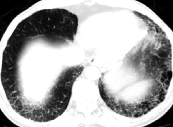 Pulmonary involvement in a 72-year-old man. CT image shows honeycomb changes in the lower lobes of both lungs. and idiopathic orbital inflammatory disease has not been systematically explored.