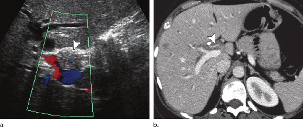 Hepatic arterial involvement in a 46-year-old woman.