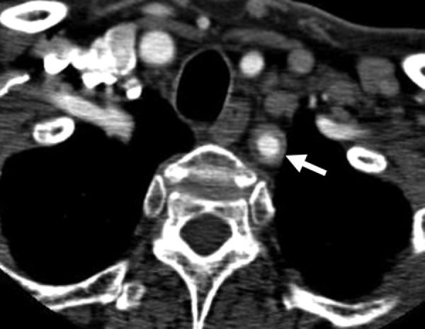 Figure 30. Subclavian arteritis in a 63-yearold woman. Contrast-enhanced CT image shows circumferential thickening of the left subclavian artery (arrow). Figure 31.