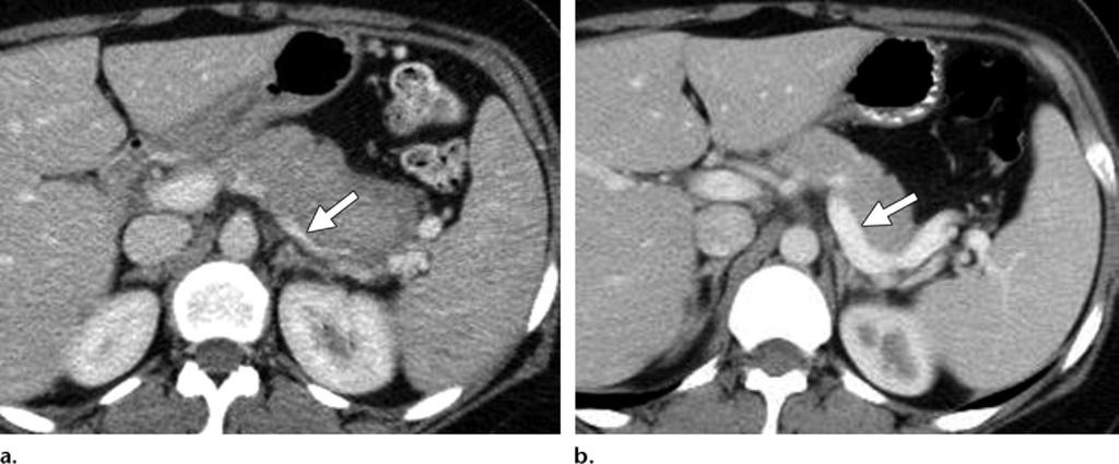 (a) Contrast-enhanced CT image shows diffuse enlargement of the pancreas, which results in attenuation of the splenic vein (arrow).
