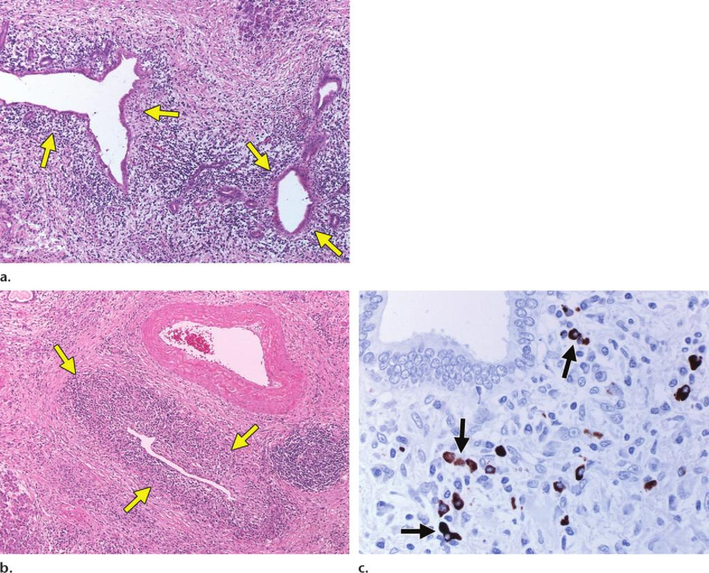 Figure 2. Histopathologic features of the pancreas in autoimmune pancreatitis.