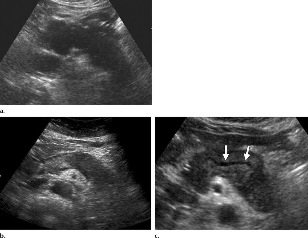 Figure 4. US appearances of autoimmune pancreatitis in three patients. (a) US image shows a diffuse hypoechoic pancreas, an appearance indicative of the diffuse type of autoimmune pancreatitis.