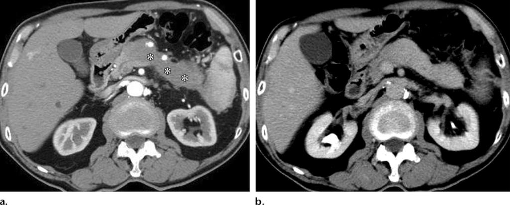 Figure 7. Autoimmune pancreatitis involving the pancreatic body and tail in an 85-year-old man.
