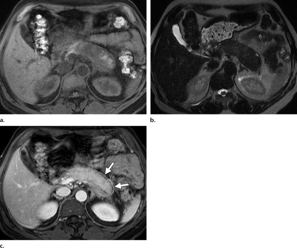 (b) On a delayed-phase CT image, the affected pancreatic parenchyma appears hyperattenuating relative to the normal pancreas. Figure 8.
