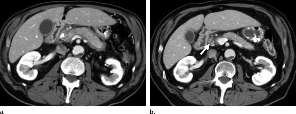1386 September-October 2011 radiographics.rsna.org Figure 9. Diffuse autoimmune pancreatitis in a 75-year-old man.