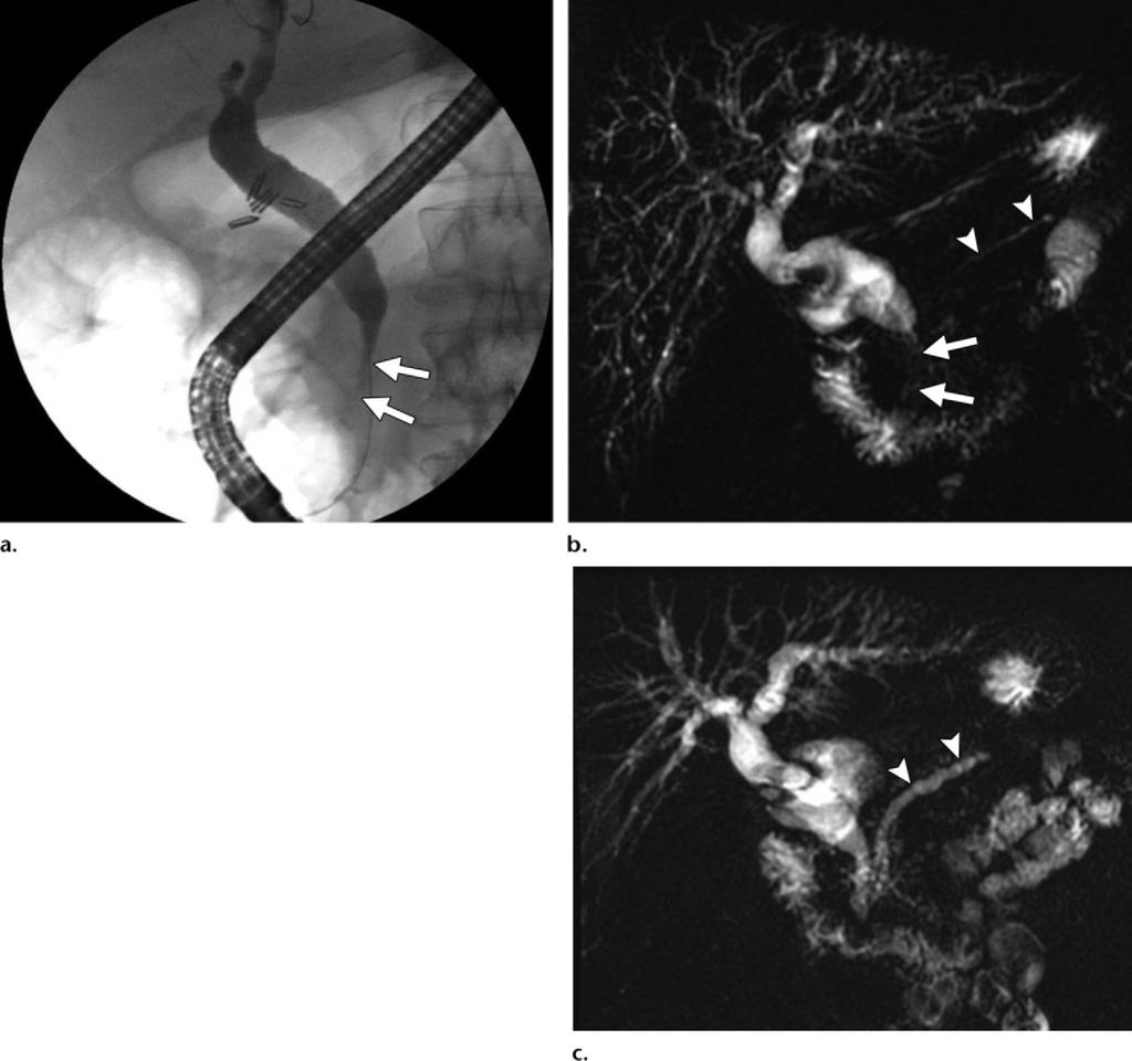 (b) Follow-up CT image obtained 8 months later, after steroid treatment, shows the pancreas, which appears mildly atrophic with no halo.