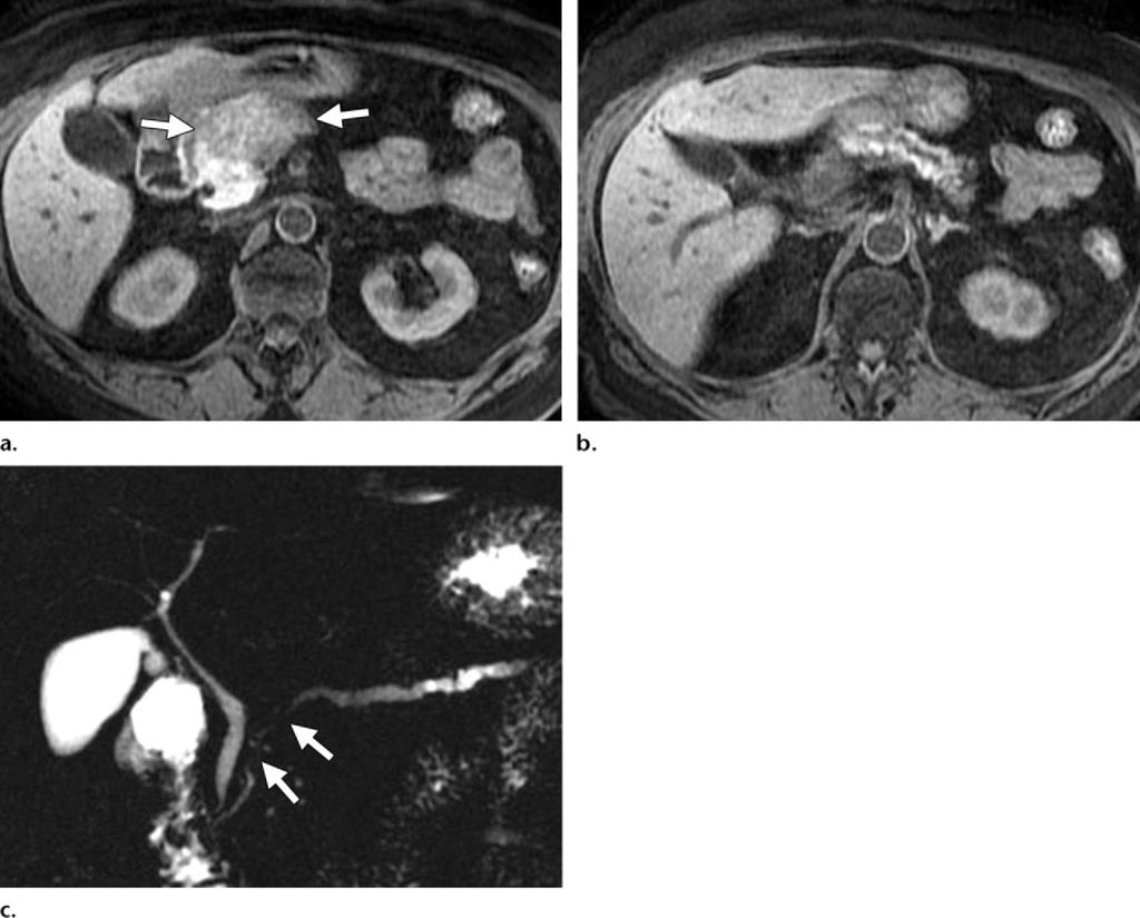 Figure 11. Focal autoimmune pancreatitis in a 69- year-old woman. (a) T1-weighted MR image shows a relatively well-demarcated lesion (arrows), which is hypointense relative to the normal pancreas.