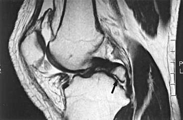 d a subchondral cyst (arrowhead) formation. 1b 2b 2a 2b Figure 2. a. Plain knee AP view shows a radiolucent defect located at medial femoral condyle (arrows) with an osteochondral loose body (arrowhead) at intercondylar notch.