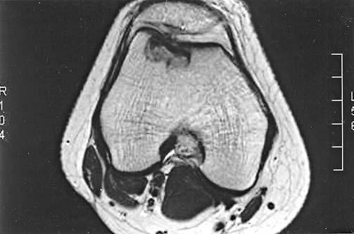 Assessment of stability of osteochondritis dissecans-mr imaging 203 3a Figure 3. a. Sagittal section FSE T2 weighted imaging shows a stable OCD at unusual location of anterior lateral femoral condyle.