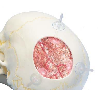 RAPIDSORB Rapid Resorbable Cranial Clamp 1 Place clamps With the cranial bone flap removed, position the cranial clamps equidistant around the opening.