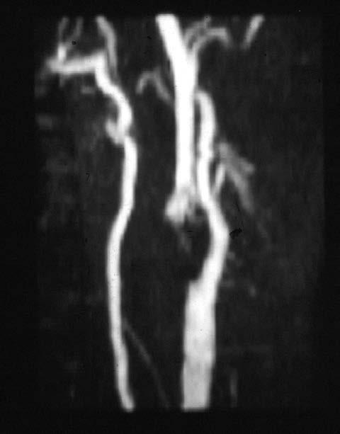 MRA ToF carotid assessment Compare