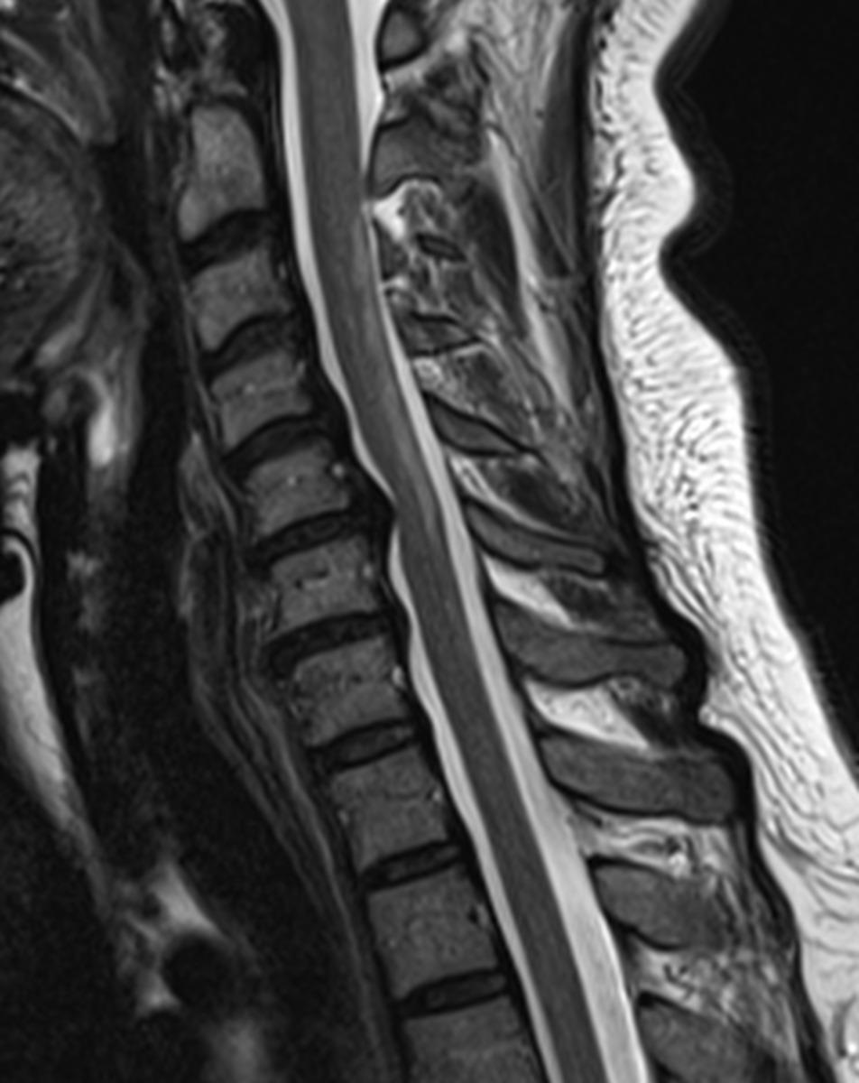 Fig. 5: Idiopathic transverse myelitis in a 34 year old woman with bilateral lower limb weakness.