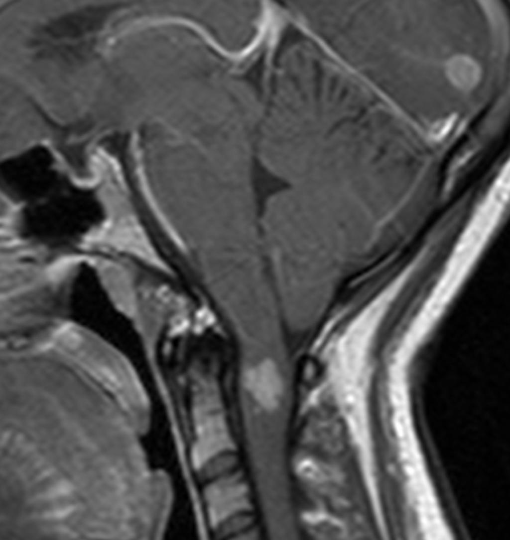 Fig. 16: Contrast enhanced sagittal T1-weighted MR demonstrates homogeneous enhancement of the mass with a well defined peripheral