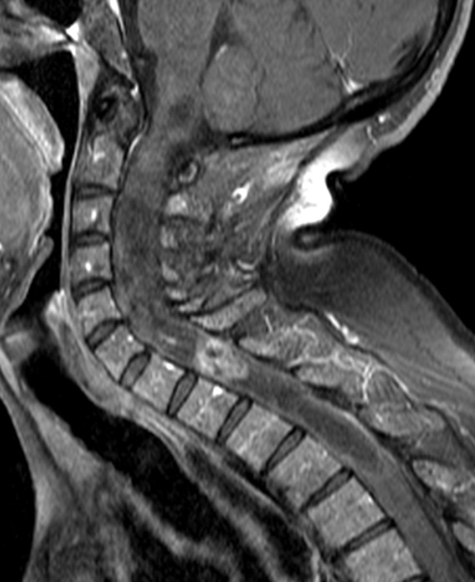 Fig. 18: Contrast enhanced sagittal T1-weighted MR in the same patient demonstrates heterogeneous enhancement of the mass with ill-defined margins superiorly.