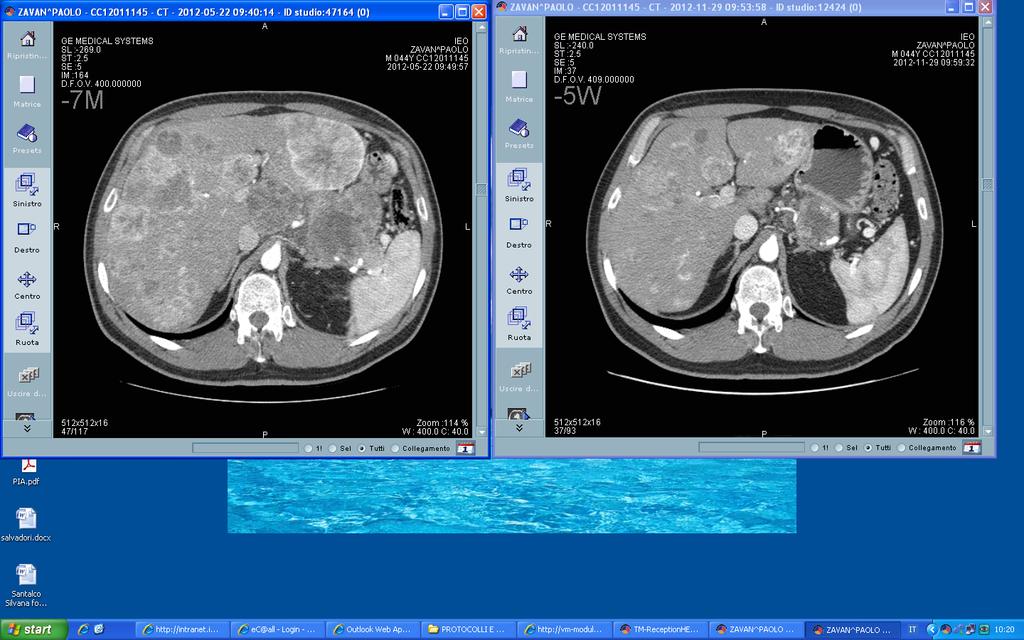 Different liver tumor load Strategia medica sequenziale: SSA! EVE! TMZ!