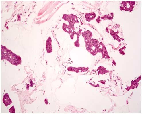 evaluated the clinicopathological differences between pure mucinous carcinoma with or without neuroendocrine differentiation.