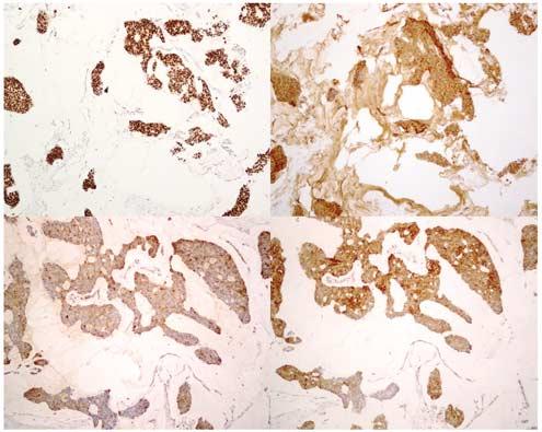 Neuroendocrine differentiation in mucinous carcinoma 570 series, only two cases did not show any estrogen receptor staining.