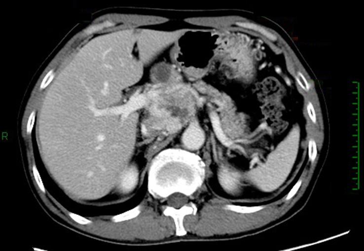 two new tumors were seen in the right lobe of liver; the larger one was sized about 4.