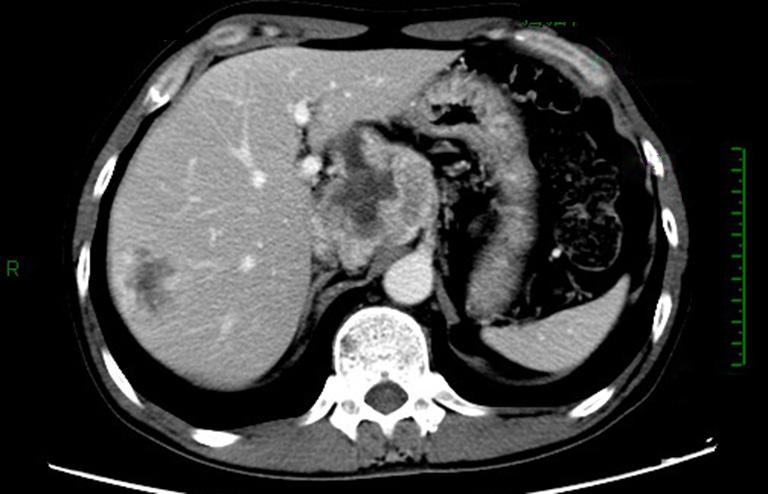 The two masses in the right lobe of liver persisted; the larger one had a longest diameter of 3.8 cm, which was also smaller than before. CT images were showed in Figure 5.