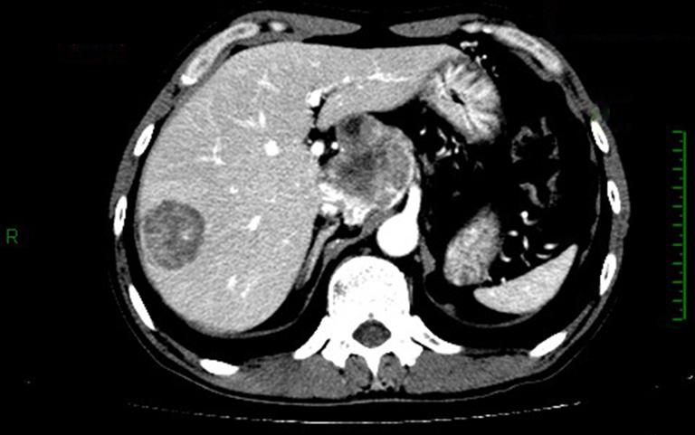 malignancy was considered. Multiple nodules and tumors were seen in the liver. The largest one was sized about 2.4 cm 3.4 cm, with blurred margin and circular enhancement.