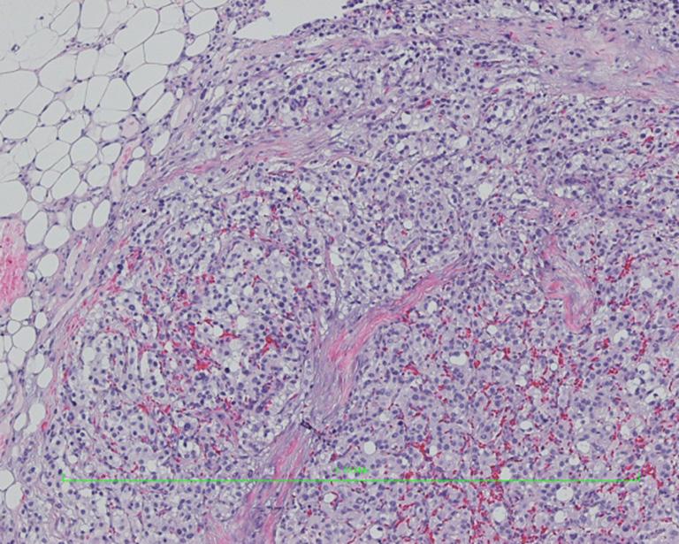 Translational Gastroenterology and Hepatology, 2016 Page 7 of 9 Figure 11 Hematoxylin-eosin (HE) staining images of nodules in lesser sac (100 ).