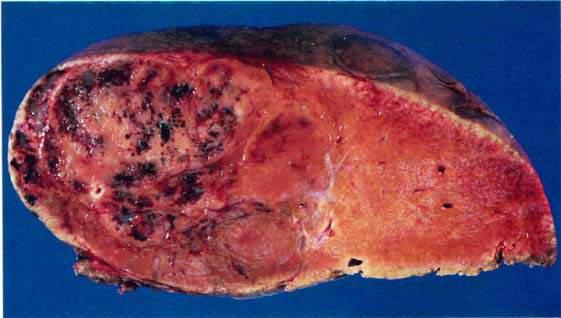 Benign Liver Masses Adil Abdalla, MBBS Creighton University-CHI Health