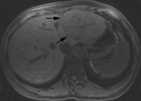 FNH MRI: Unenhanced T1: isointense, hypointense central scar T2: