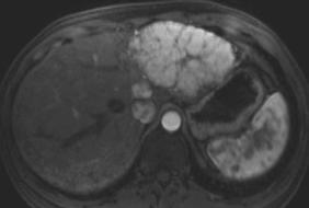 Cancer Imaging 2007 Focal Nodular Hyperplasia, Treatment: