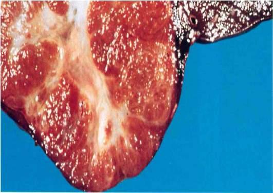 Focal Nodular Hyperplasia From: Tumors of the Liver and Intrahepatic Bile Ducts by Ishak Focal Nodular Hyperplasia Second most common benign tumor of the liver. Prevalence 2.5-8%.