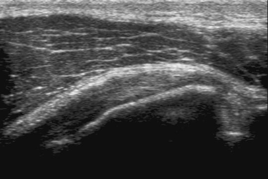 LT LT Legend: Arrow, long head of the biceps tendon; dashed line, insertion of the subscapularis tendon;