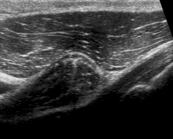 the conjoined tendon and the anterior aspect of the subacromial subdeltoid bursa.
