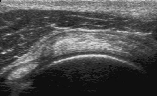 5 Refer to the intraarticular portion of the biceps as a landmark to obtain proper transducer orientation for imaging the supraspinatus.
