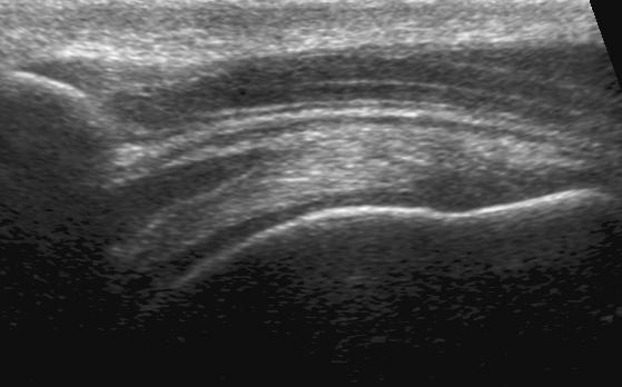 Between the supraspinatus and the deltoid, the normal subacromial-subdeltoid bursa appears as a thin hypoechoic band.
