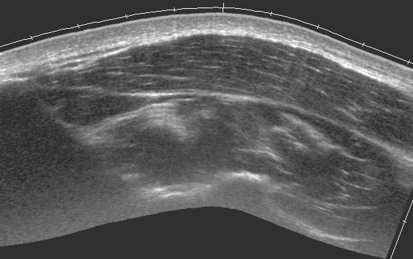 Use the spine of the scapula as the landmark to distinguish the supraspinous fossa (transducer shifted-up) from the infraspinous fossa (transducer shifted-down) on sagittal planes.